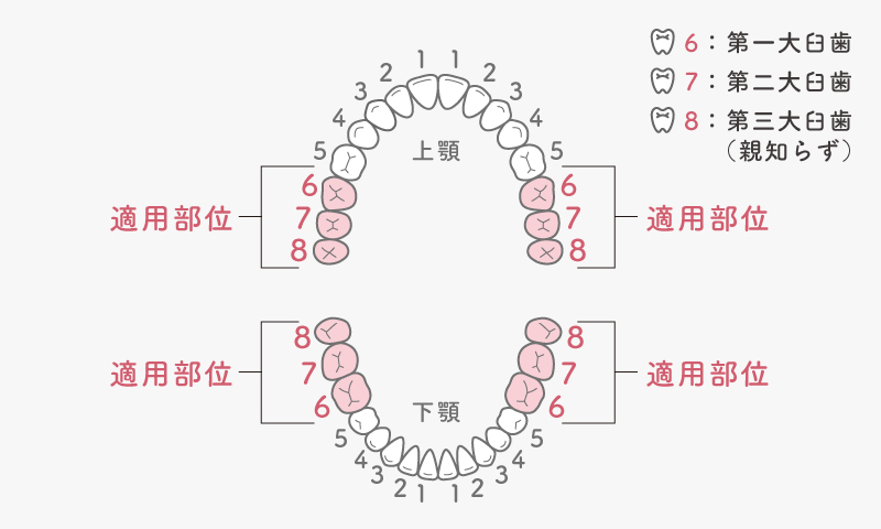 保険適用CAD/CAMインレー